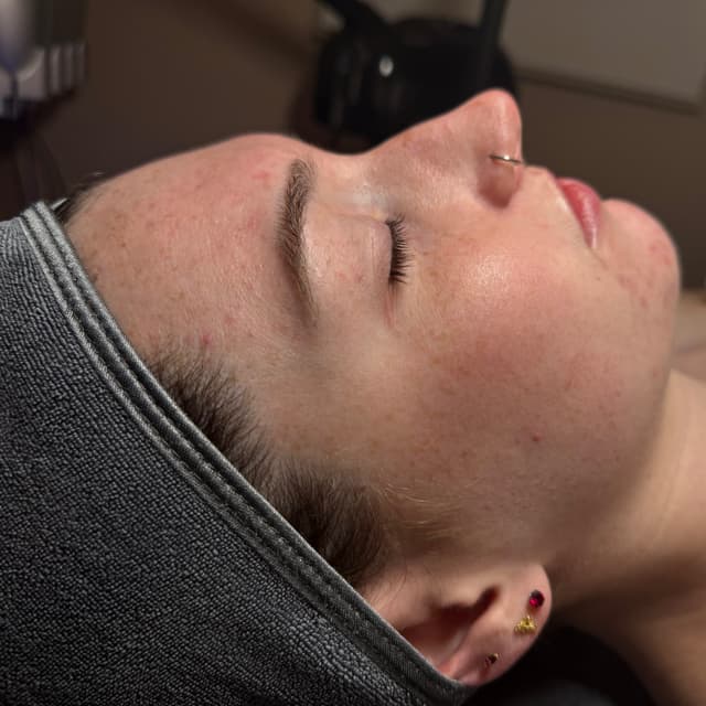 Acne Facial Package at MadSkin Esthetics in Colorado Springs, CO